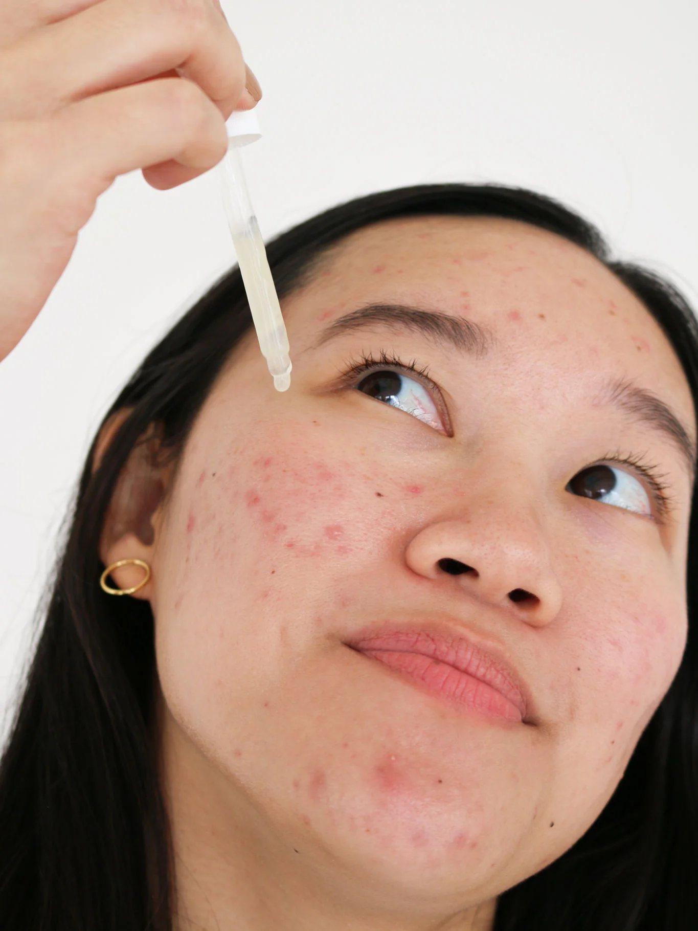 Postbiotic Acne Serum - Image 3